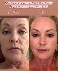 OUHOE - Bee Venom Botox Wrinkle Cream